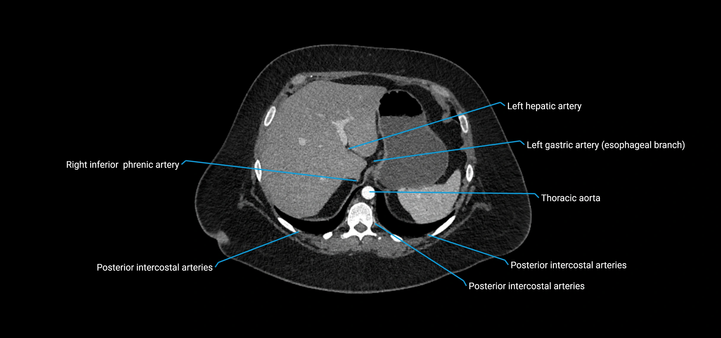 CTA abdomen axial cross sectional anatomy labelled image_33 (2).webp